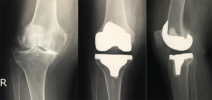 人工膝関節置換手術について／関節外科センター