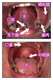ん 口腔 が 口腔がんのセルフチェックをしましょう｜口腔外科相談室｜日本口腔外科学会