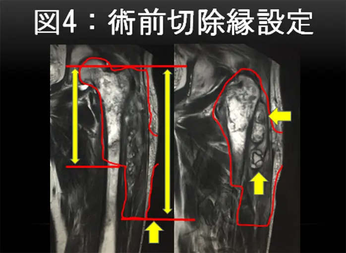 大腿骨近位部軟骨肉腫の切迫骨折に対する広範切除後に人工靱帯