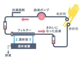 HD(血液透析療法)