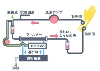 オンラインHDF(血液透析ろ過療法)