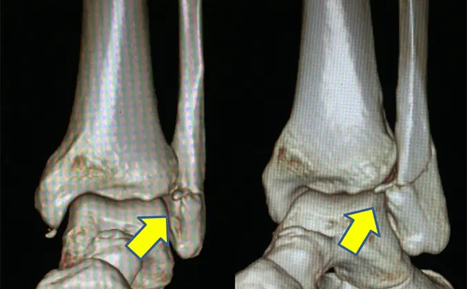 Displaced intra-articular calcaneal fractures treated with Calcanail® and  additional screw fixation of the thalamic surface through lateral subtalar  arthroscopy - Foot & Ankle Surgery: Techniques, Reports & Cases