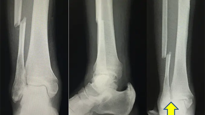 Displaced intra-articular calcaneal fractures treated with Calcanail® and  additional screw fixation of the thalamic surface through lateral subtalar  arthroscopy - Foot & Ankle Surgery: Techniques, Reports & Cases