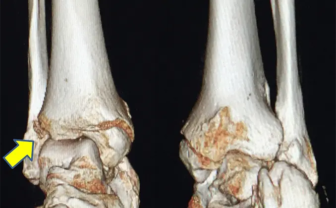 足関節脱臼骨折・Syndesmosis injury症例 | 千葉西総合病院